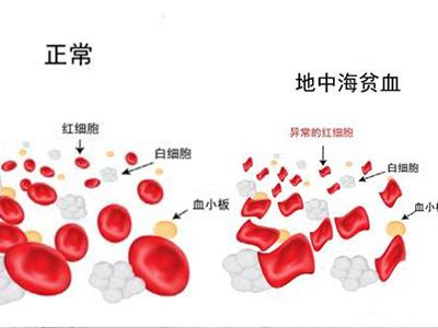 地中海贫血 地中海贫血