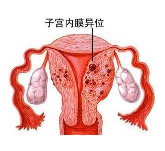 为什么会发生子宫内膜异位症？该怎