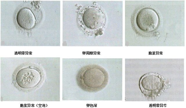 从正常卵子和异常卵子的区别，细说试管婴儿成功率的关键作用