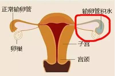 输卵管积水还能疏通吗？可能导致不