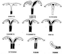 幼稚子宫