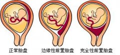 胎盘位置低，还能“长”上去吗？